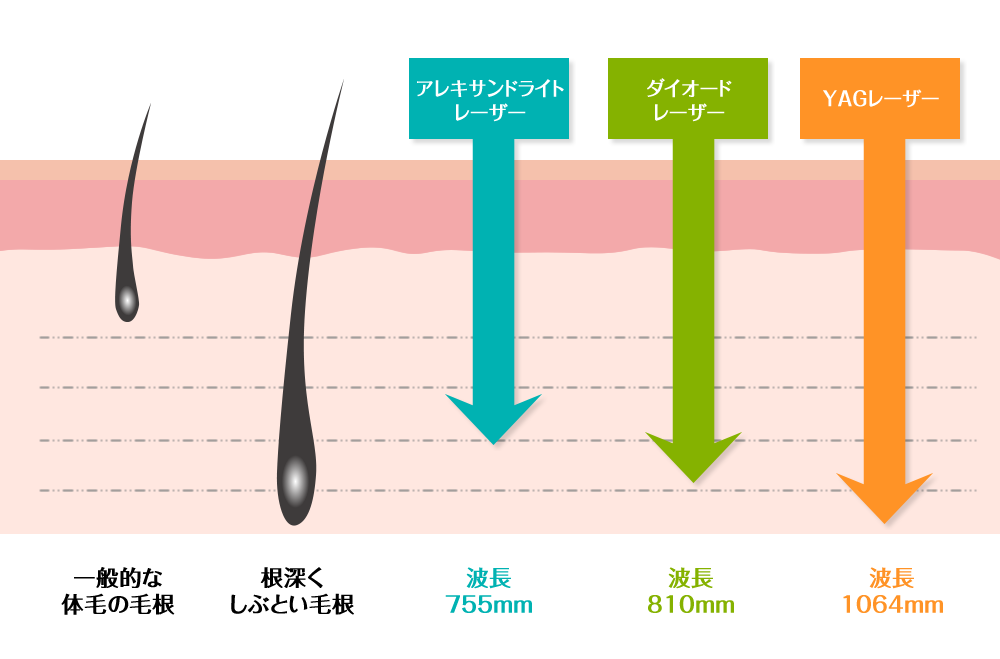 レーザーの波長の違い