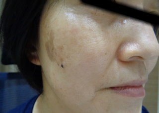 50代シミへのBBLの症例（2）