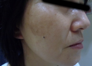 50代シミへのBBLの症例（2）