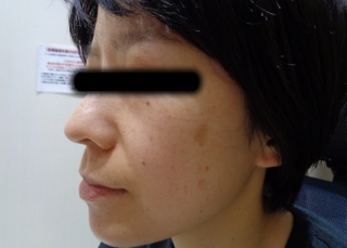 30代シミへのBBLの症例（1）
