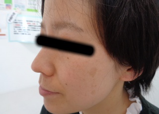 30代シミへのBBLの症例（1）