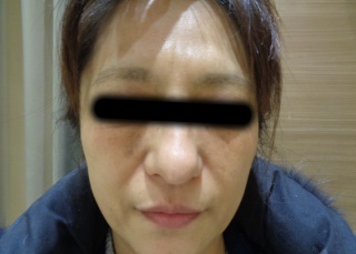 50代シミへのBBLの症例（3）