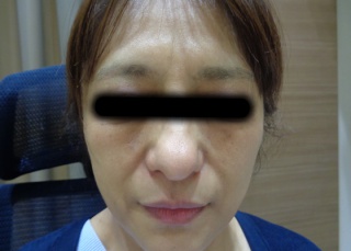 50代シミへのBBLの症例（3）